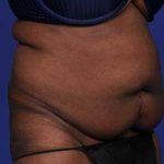 Liposuction and VASERLipo Before & After Patient #1035