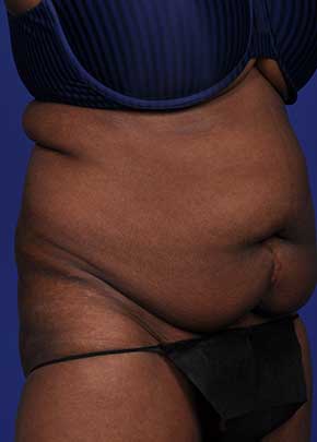Liposuction and VASERLipo Before & After Patient #1035