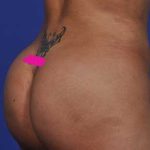 Liposuction and VASERLipo Before & After Patient #1033
