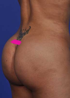 Liposuction and VASERLipo Before & After Patient #1033