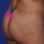 Liposuction and VASERLipo Before & After Patient #1033
