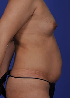 Liposuction and VASERLipo Before & After Patient #1032