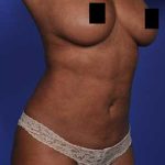 Liposuction and VASERLipo Before & After Patient #1030