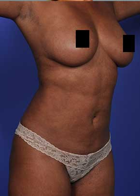 Liposuction and VASERLipo Before & After Patient #1030