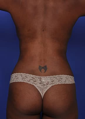 Liposuction and VASERLipo Before & After Patient #1030