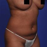 Liposuction and VASERLipo Before & After Patient #1030