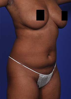 Liposuction and VASERLipo Before & After Patient #1030