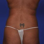 Liposuction and VASERLipo Before & After Patient #1030
