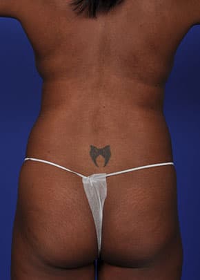 Liposuction and VASERLipo Before & After Patient #1030