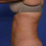 Liposuction and VASERLipo Before & After Patient #1029