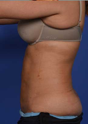 Liposuction and VASERLipo Before & After Patient #1029