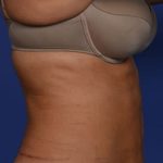Liposuction and VASERLipo Before & After Patient #1029
