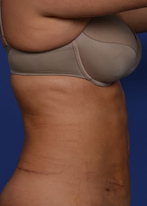 Liposuction and VASERLipo Before & After Patient #1029