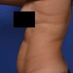 Liposuction and VASERLipo Before & After Patient #1029
