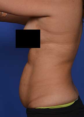 Liposuction and VASERLipo Before & After Patient #1029