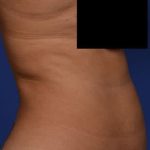 Liposuction and VASERLipo Before & After Patient #1029
