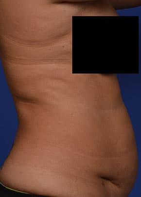 Liposuction and VASERLipo Before & After Patient #1029