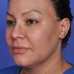 Liposuction and VASERLipo Before & After Patient #1025
