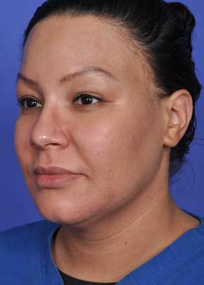 Liposuction and VASERLipo Before & After Patient #1025
