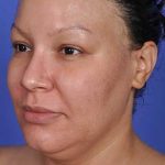 Liposuction and VASERLipo Before & After Patient #1025