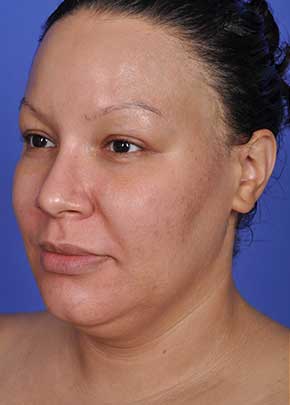 Liposuction and VASERLipo Before & After Patient #1025