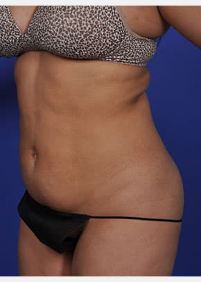 Liposuction and VASERLipo Before & After Patient #1024