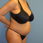 Liposuction and VASERLipo Before & After Patient #1022