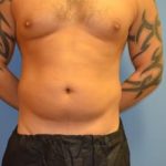 Liposuction and VASERLipo Before & After Patient #1021