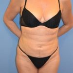 Liposuction and VASERLipo Before & After Patient #1020