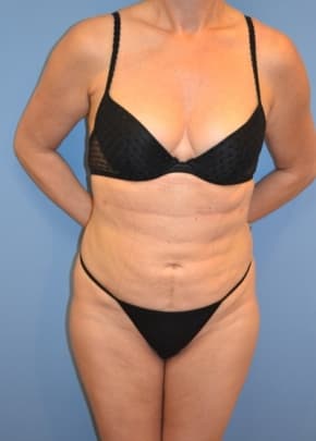 Liposuction and VASERLipo Before & After Patient #1020