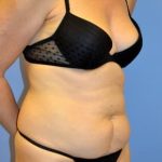 Liposuction and VASERLipo Before & After Patient #1020