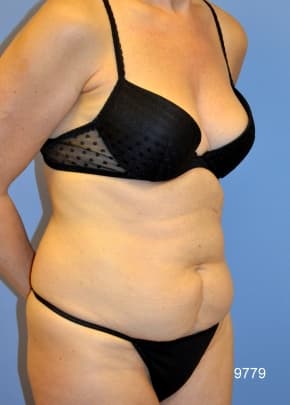 Liposuction and VASERLipo Before & After Patient #1020