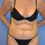 Liposuction and VASERLipo Before & After Patient #1020