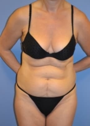 Liposuction and VASERLipo Before & After Patient #1020