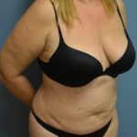 Liposuction and VASERLipo Before & After Patient #1019
