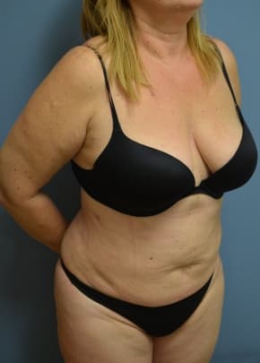 Liposuction and VASERLipo Before & After Patient #1019