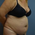 Liposuction and VASERLipo Before & After Patient #1019