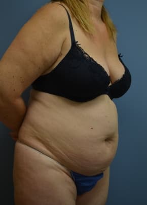 Liposuction and VASERLipo Before & After Patient #1019