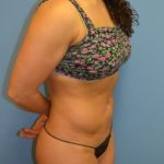 Liposuction and VASERLipo Before & After Patient #1017