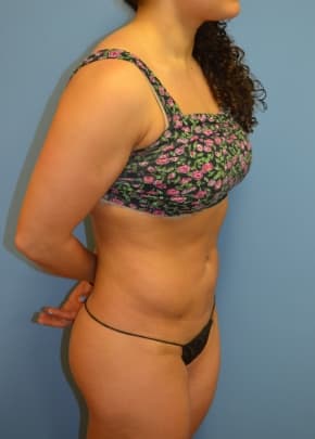 Liposuction and VASERLipo Before & After Patient #1017