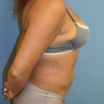 Liposuction and VASERLipo Before & After Patient #1016