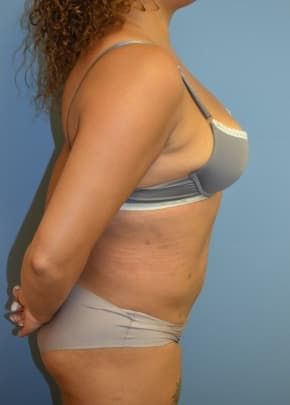 Liposuction and VASERLipo Before & After Patient #1016