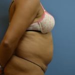 Liposuction and VASERLipo Before & After Patient #1016