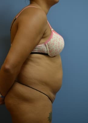 Liposuction and VASERLipo Before & After Patient #1016