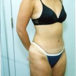 Liposuction and VASERLipo Before & After Patient #1015
