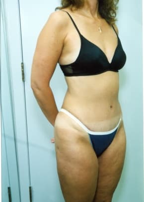 Liposuction and VASERLipo Before & After Patient #1015
