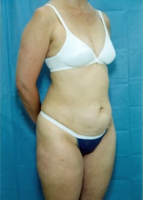 Liposuction and VASERLipo Before & After Patient #1015