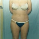 Liposuction and VASERLipo Before & After Patient #1014