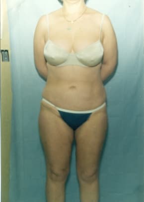 Liposuction and VASERLipo Before & After Patient #1014