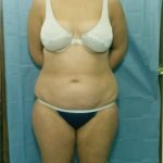 Liposuction and VASERLipo Before & After Patient #1014